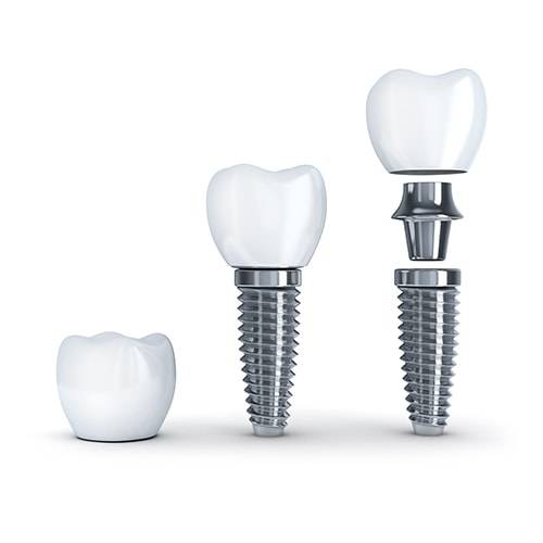 Implant and Crown